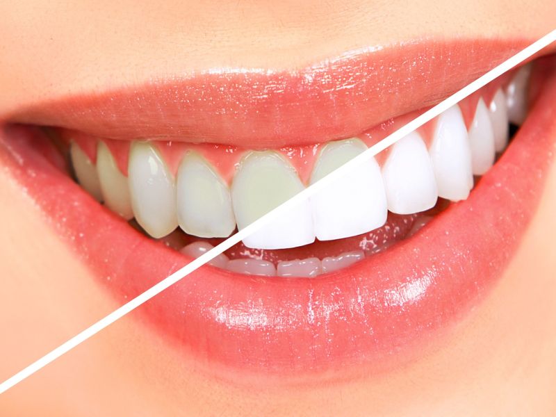 Health tips : Easy home remedies to clean plaque and tartar to get healthy white teeth | दातांचा पिवळटपणा आणि काळे डाग कसे साफ कराल? डेंटिस्ट्सनी सांगितले चमकदार दातांचे उपाय