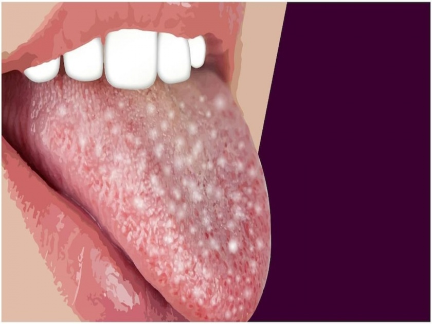 These are the reason behind white spot on your tongue | जिभेवर दिसणाऱ्या व्हाइट स्पॉट्सची ही आहेत कारणं, दुर्लक्ष करणं पडू शकतं महागात