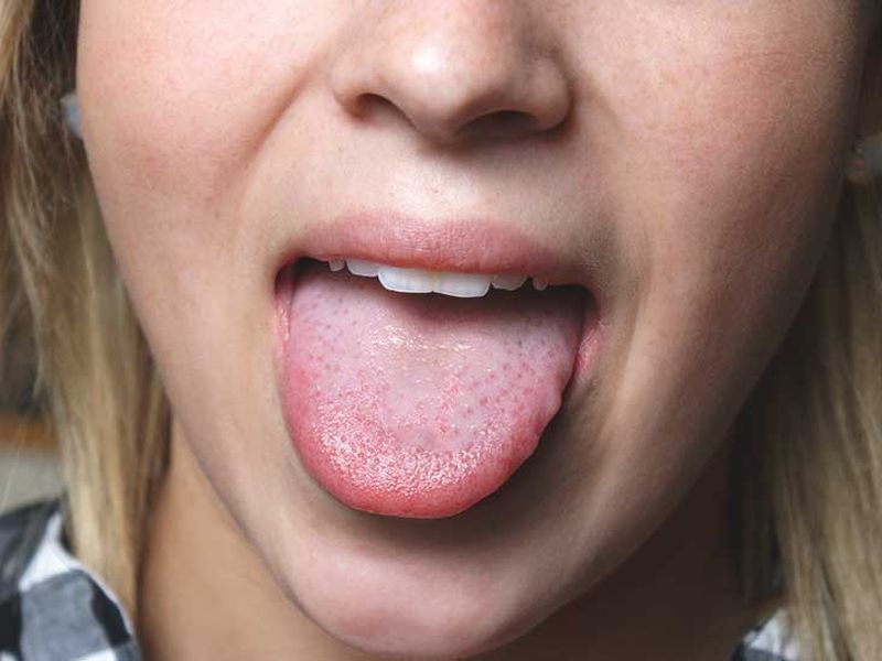 Here are the tips to remove spots from tongue | जिभेवर काळे डाग आहेत? या उपायांनी करा दूर!