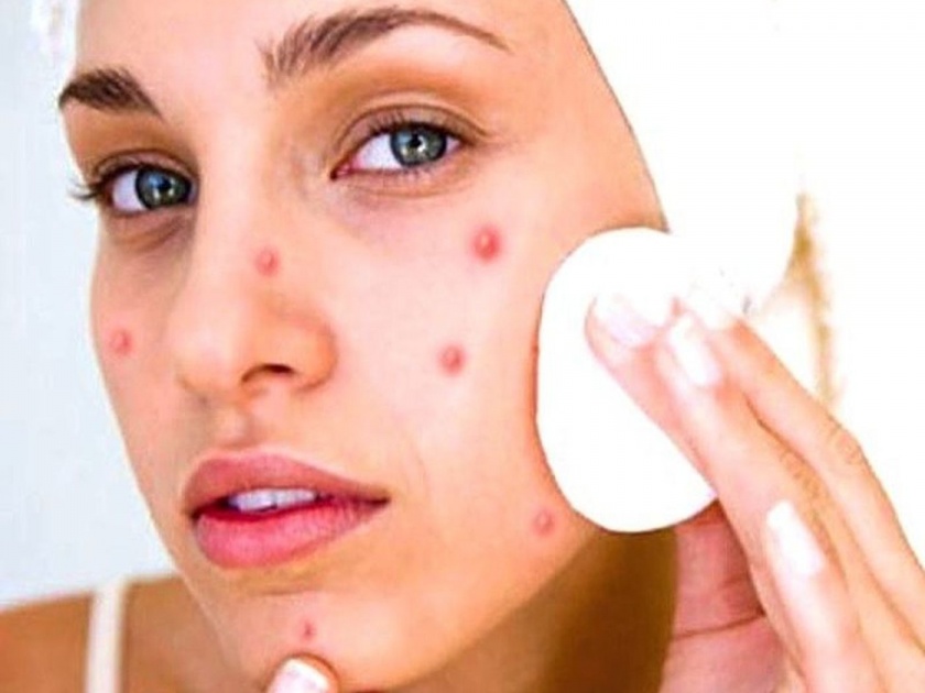 These are the common causes of pimples on the skin myb | घरी असो किंवा बाहेर सतत पिंपल्स येण्यासाठी 'या' गोष्टी ठरतात कारणीभूत