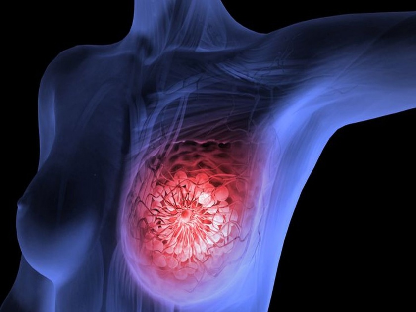 Signs of breast cancer in women | स्त्रीयांमध्ये वाढतोय ब्रेस्ट कॅन्सरचा धोका, या लक्षणांकडे चुकूनही करू नका कानाडोळा  