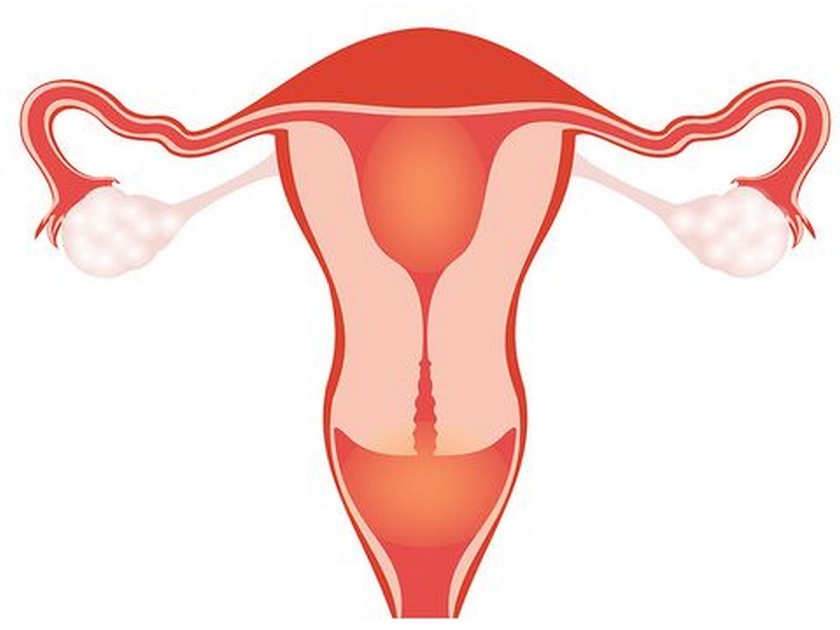 Restrictions on uterus removal for a woman within 5 years | ३५ वर्षांच्या आतील महिलेचे गर्भाशय काढण्यावर निर्बंध