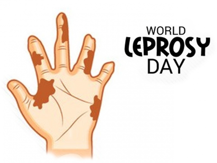 World Leprosy Day 2020:Know the symptoms, types and solutions of leprosy | World Leprosy Day 2020 : जाणून घ्या कुष्ठरोगाची लक्षणं, प्रकार आणि उपाय