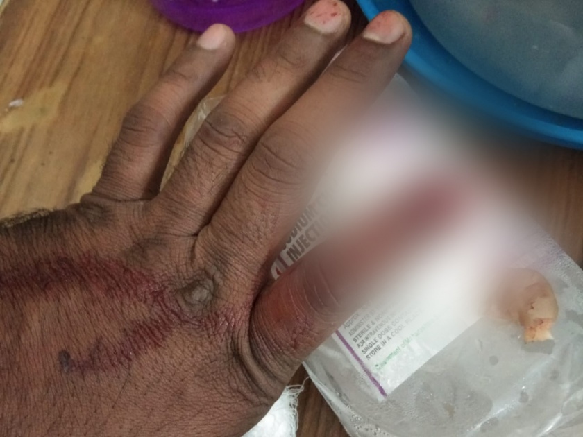 Nude Insane person taken bite of police's index finger and ... | नग्न मनोरुग्णाने पोलिसाच्या बोटाला घेतला चावा अन्...  