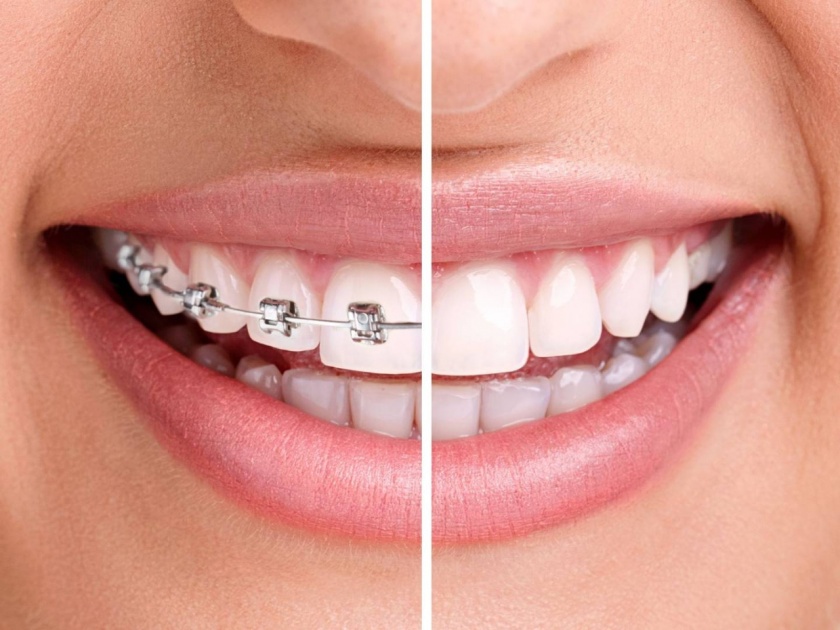 Benefits and side effects of teeth braces MYB | खरंच दातांना तार लावणं फायद्याचं असतं का? कशी घ्याल काळजी...