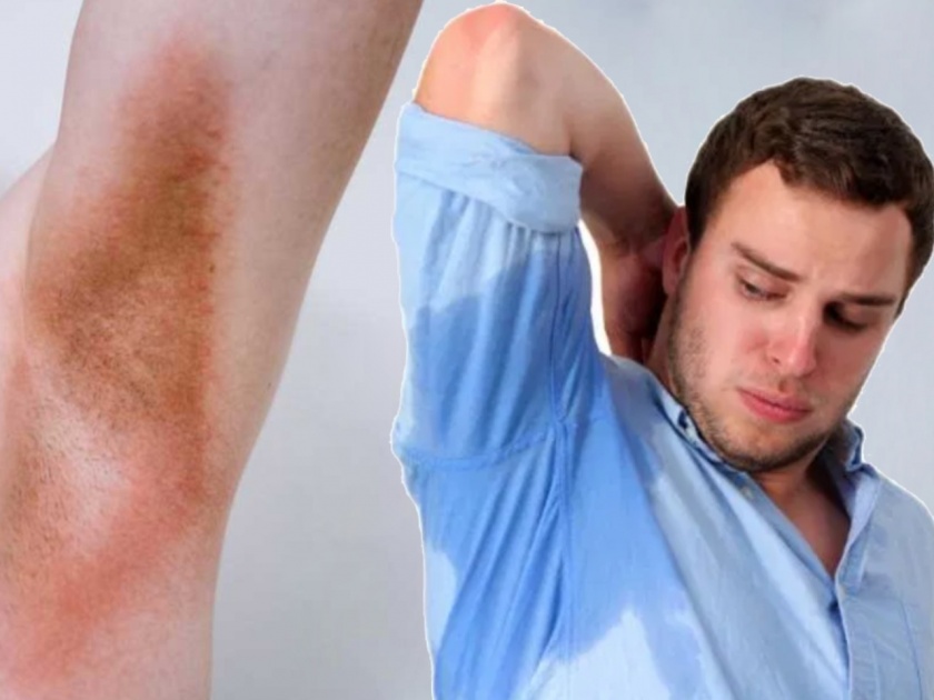 How to prevent from skin infection ,Sweating can cause skin infections in the underarms myb | घामामुळे होतं अंडरआर्म्सचं स्किन इन्फेक्शन, खाजवण्यापेक्षा 'या' उपायांनी इन्फेक्शनला ठेवा दूर