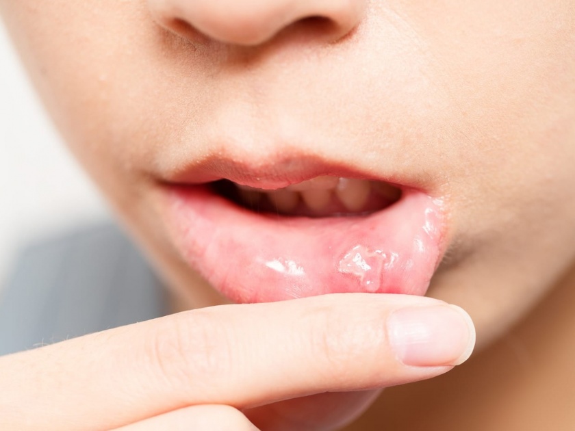 Home remedies for preventing mouth ulcer myb | वाढती उष्णता आणि पित्तामुळे तुम्हालाही होऊ शकतो तोंडातील अल्सर; 'असा' करा बचाव