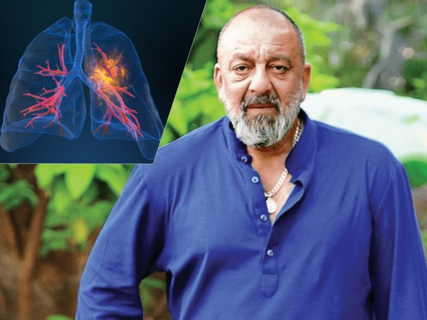 lung cancer 6 big reasons for disease know symptoms causes and prevention | 'या' ६ कारणांमुळे कोणालाही होऊ शकतो फुफ्फुसांचा कॅन्सर; वाचा लक्षणं आणि बचावाचे उपाय