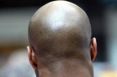 Filed a case of concealment of baldness by husband, complaint of newlyweds | नवऱ्याने टक्कल लपवल्याने गुन्हा दाखल, नवविवाहितेची तक्रार