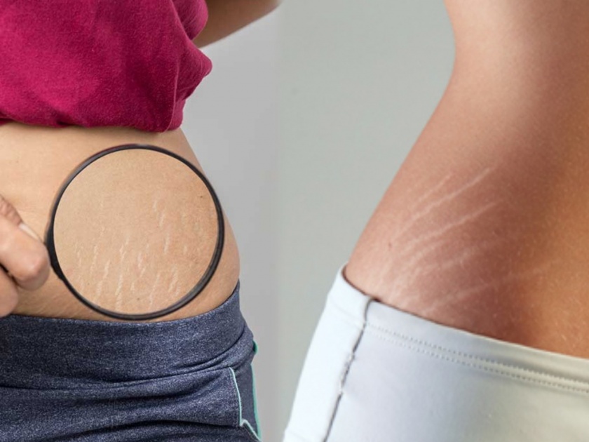 How to remove stretch marks, Take care of your skin with 7 tips given by experts | आता स्ट्रेच मार्क्सची चिंता सोडा; एक्सपर्ट्सनी दिलेल्या ७ उपायांनी त्वचेची काळजी घ्या