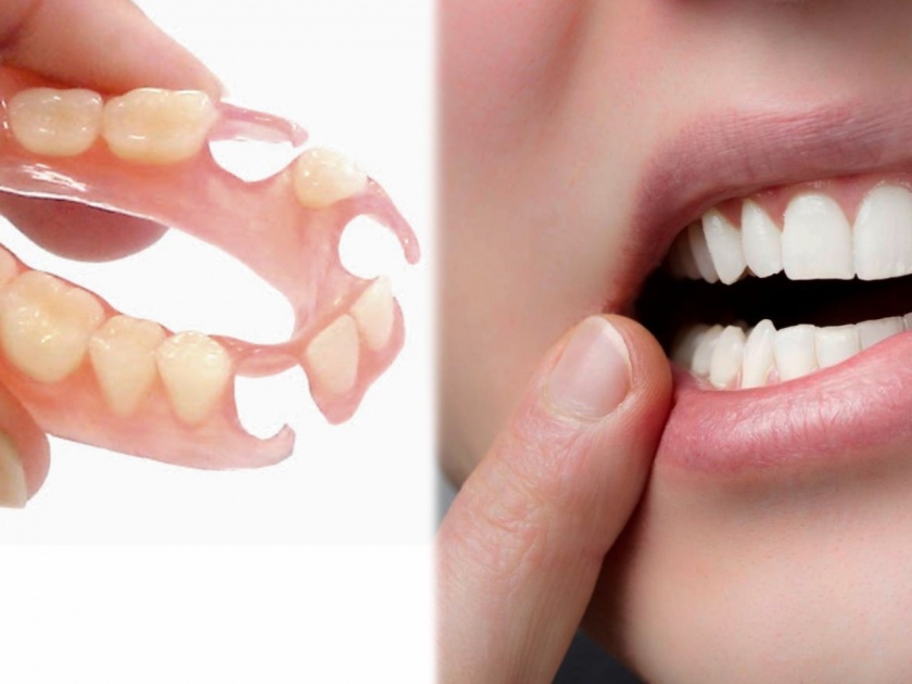 How denture or artificial teeth can help in maintaining oral health explained by a dentist | एकदा दात पडल्यानंतर नवीन दात लावणं कितपत गरजेचं? जाणून घ्या डेंटिस्ट्सचा सल्ला