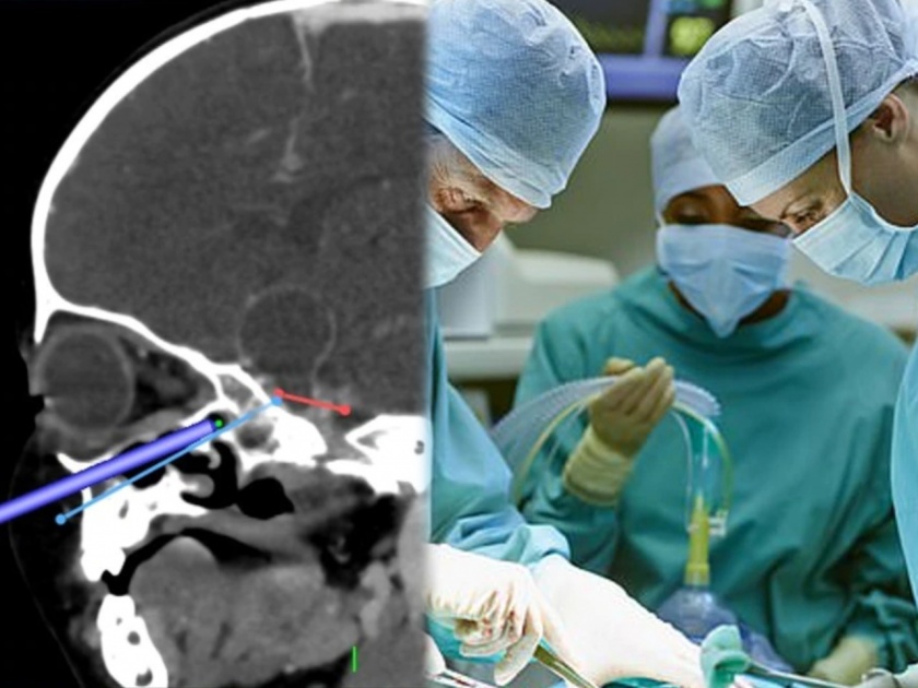 A 16 month girl create world record for operating brain tumor through nose | १६ महिन्यांच्या मुलीच्या नाकातून काढला ब्रेन ट्यूमर; जगातील सगळ्यात कमी वयाच्या चिमुकलीचे ऑपरेशन