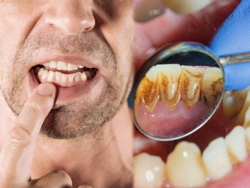 People having crooked teeth should avoid eating this food items | Oral Health Care Tips : वाकडे तिकडे दात असतील तर 'या' पदार्थांचे सेवन आजच बंद करा; दात कधी किडतील कळणारही नाही