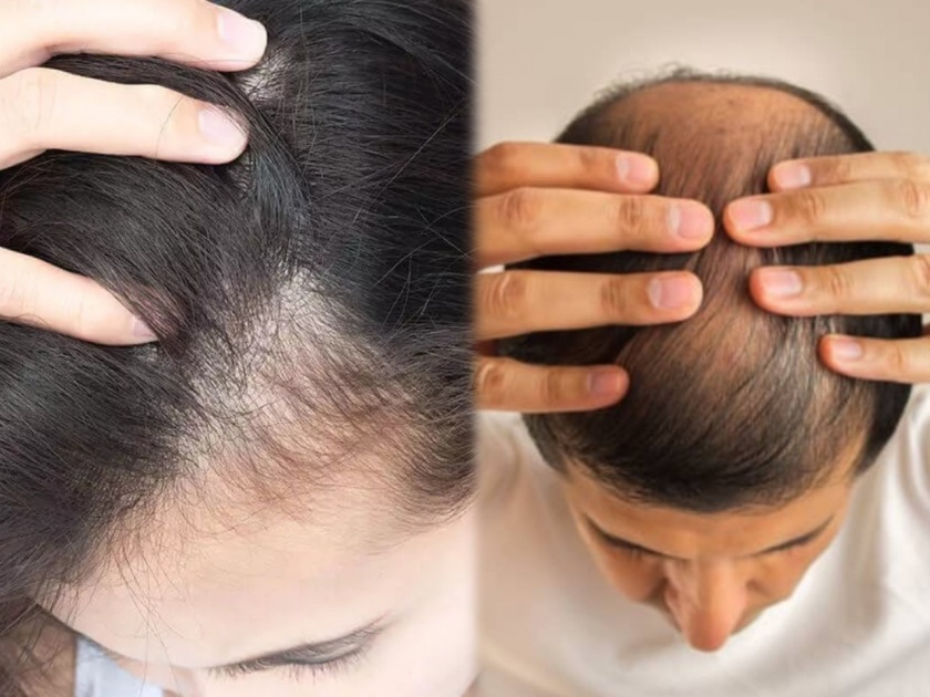 Alopecia Areata: Alopecia areata a disease that causes unpredictable hair loss has no cure yet | Alopecia Areata: 'या' आजारामुळे कमी वयातच वेगानं गळतात केस; वाचा दाट, काळ्याभोर केसांसाठी सोपा उपाय