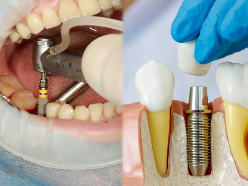 Avoid these substances after dental implants, know the advice of experts | रोजच्या खाण्यातील पदार्थांमुळे दातांचं होतंय मोठं नुकसान; पांढऱ्या, मजबूत दातांसाठी तज्ज्ञांचा मोलाचा सल्ला