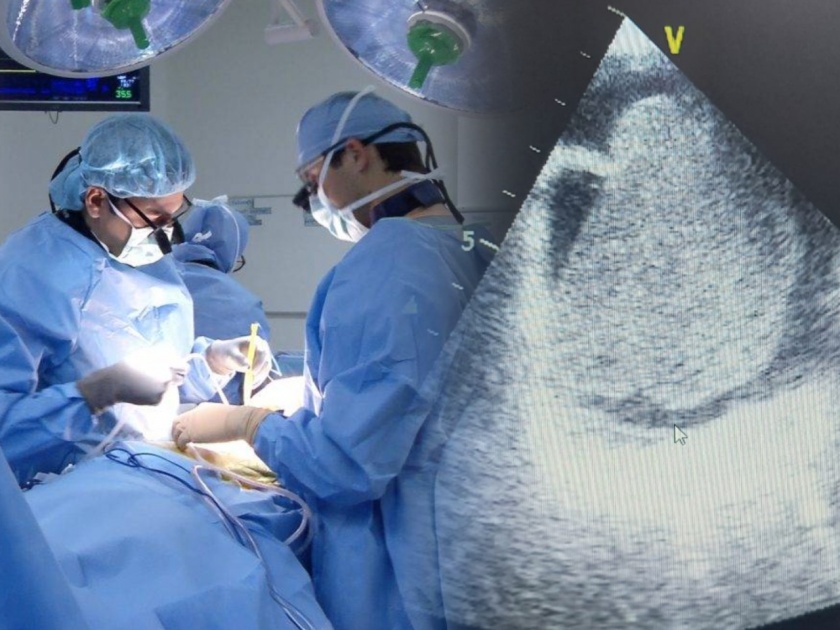 CoronaVirus News 7 cm tumor removed from corona-infected woman's heart in miraroad | CoronaVirus News : कोरोनाबाधित महिलेच्या हृदयातून काढली चक्क ७ सेंटिमीटरची गाठ