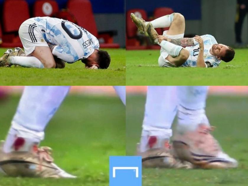 Copa America 2021: Argentina beat Colombia in semis shootout, Lionel Messi Plays With Bleeding Ankle | Copa America 2021: पायातून वाहत होतं रक्त तरीही लिओनेल मेस्सी खेळला अन् अर्जेंटिनानं फायनलमध्ये प्रवेश केला!