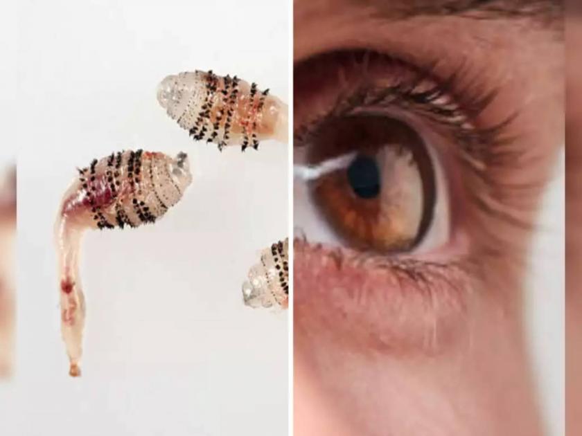 ​Man's 'itchy eye' turns out to be a dozen squirming fly larvae around his cornea​ | ...अन् 'त्याच्या' डोळ्यात चक्क माशीने अंडी घातली; सत्य समजताच पायाखालची जमीन सरकली