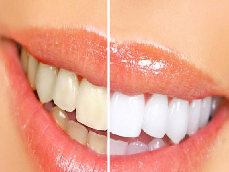 These domestic remedies tooth whiten, make them shiny and shine | या घरगुती उपायांनी दातांचा पिवळेपणा घालवा, बनवा चमकदार