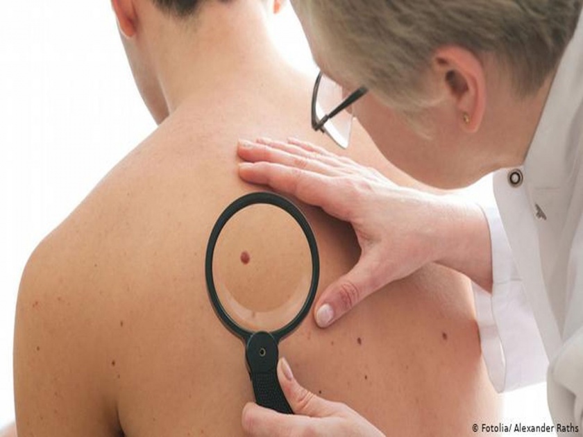 Know the symptoms ofmelanoma skin cancer | शरीरावर असणारा तीळ त्वचेच्या कॅन्सरचा आहे की नाही?, असं ओळखा