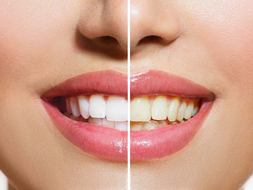 Know the home remedies can help you to whiten your teeth | महागड्या टुथपेस्टमुळे नाही तर 'या' ५ गोष्टींमुळे दात होतील चमकदार 
