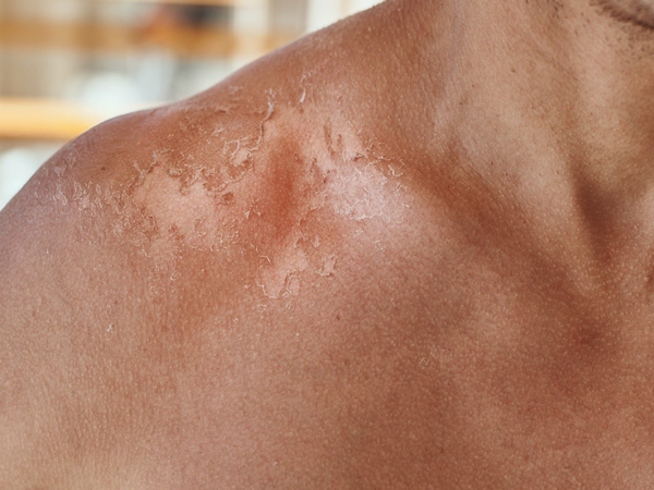 Skin injuries spike during heat waves in India - www.lokmattimes.com