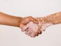 Signs to detect Vitiligo - Hindi News | Signs to detect Vitiligo | Latest lifestyle News at Lokmattimes.com