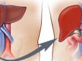 59-yr-old gets new life with liver transplant from a brain-dead donor - Hindi News | 59-yr-old gets new life with liver transplant from a brain-dead donor | Latest international News at Lokmattimes.com