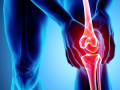 Early detection of 'osteoarthritis' may allow therapy that improves joint health: Researchers - Hindi News | Early detection of 'osteoarthritis' may allow therapy that improves joint health: Researchers | Latest health News at Lokmattimes.com