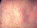 Measles outbreak spreads in US - Hindi News | Measles outbreak spreads in US | Latest health News at Lokmattimes.com