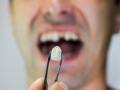 New technique to replace lost teeth: Experts - Hindi News | New technique to replace lost teeth: Experts | Latest health News at Lokmattimes.com
