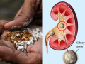 Pan masala can cause larger kidney stones: Experts - Hindi News | Pan masala can cause larger kidney stones: Experts | Latest health News at Lokmattimes.com