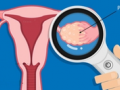 Routine screening key for early detection of ovarian cancer: Experts - Hindi News | Routine screening key for early detection of ovarian cancer: Experts | Latest health News at Lokmattimes.com