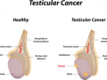 Why young men must be aware of testicular cancer - Hindi News | Why young men must be aware of testicular cancer | Latest health News at Lokmattimes.com