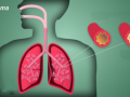 Targeted therapies, diagnostics remain concern for severe asthma: Report - Hindi News | Targeted therapies, diagnostics remain concern for severe asthma: Report | Latest health News at Lokmattimes.com