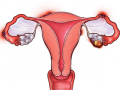 Doctors flag concerns over recurrence of uterine fibroids in young women - Hindi News | Doctors flag concerns over recurrence of uterine fibroids in young women | Latest health News at Lokmattimes.com