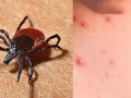 TN Health Department on high alert as scrub typhus cases rise - Hindi News | TN Health Department on high alert as scrub typhus cases rise | Latest health News at Lokmattimes.com