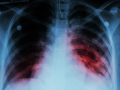 Singapore reports 1,156 new tuberculosis cases in 2024, lower than 2023 - Hindi News | Singapore reports 1,156 new tuberculosis cases in 2024, lower than 2023 | Latest health News at Lokmattimes.com