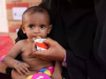 Malnutrition is 'crisis inside the crisis' in Yemen: NGO - Hindi News | Malnutrition is 'crisis inside the crisis' in Yemen: NGO | Latest health News at Lokmattimes.com