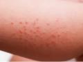 Childhood allergies skin, lungs begin in our gut: Study - Hindi News | Childhood allergies skin, lungs begin in our gut: Study | Latest international News at Lokmattimes.com