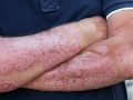 Global prevalence of atopic dermatitis to reach 42.42 mn by 2033: Report - Hindi News | Global prevalence of atopic dermatitis to reach 42.42 mn by 2033: Report | Latest health News at Lokmattimes.com