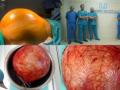 Doctors at Hyderabad hospital remove football-sized kidney tumour - Hindi News | Doctors at Hyderabad hospital remove football-sized kidney tumour | Latest health News at Lokmattimes.com