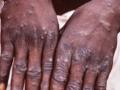 Monkeypox cases in Britain exceed 500 - Hindi News | Monkeypox cases in Britain exceed 500 | Latest international News at Lokmattimes.com