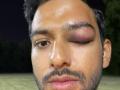 Former India U-19 star Unmukt Chand suffers serious eye injury; says grateful to have survived a possible disaster - Hindi News | Former India U-19 star Unmukt Chand suffers serious eye injury; says grateful to have survived a possible disaster | Latest cricket News at Lokmattimes.com