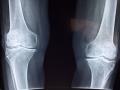 Knee replacement surgeries fell 40% in India due to Covid: Experts - Hindi News | Knee replacement surgeries fell 40% in India due to Covid: Experts | Latest health News at Lokmattimes.com