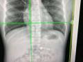 Researchers detect long-Covid's impact via simple chest X-rays - Hindi News | Researchers detect long-Covid's impact via simple chest X-rays | Latest technology News at Lokmattimes.com