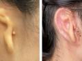 Woman implanted with 3D-printed ear made from her own cells - Hindi News | Woman implanted with 3D-printed ear made from her own cells | Latest technology News at Lokmattimes.com