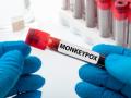 UK trying out smaller monkeypox vax doses amid shortage - Hindi News | UK trying out smaller monkeypox vax doses amid shortage | Latest health News at Lokmattimes.com