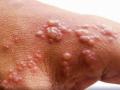 Monkeypox virus detected in testes of non-human primate survivors - Hindi News | Monkeypox virus detected in testes of non-human primate survivors | Latest health News at Lokmattimes.com