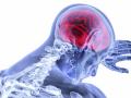 UK researchers develop new tool to reduce stroke risk - Hindi News | UK researchers develop new tool to reduce stroke risk | Latest international News at Lokmattimes.com